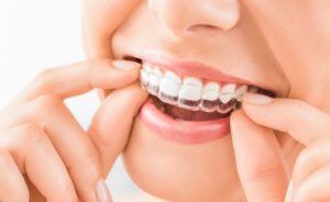 Person putting Invisalign braces over their teeth