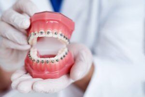 Set of false teeth with braces on them