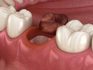 Illustration showing close up of empty tooth socket