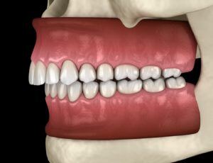Model of misaligned teeth