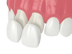 Illustration of veneers being applied to teeth