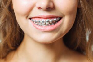 Close up of woman wearing braces